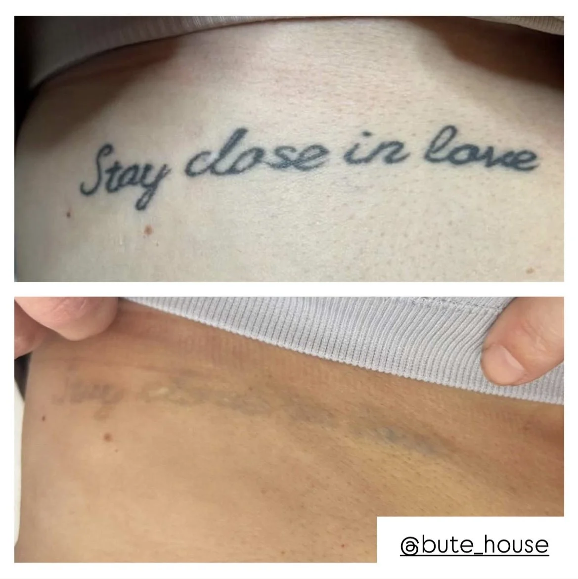 Tattoo removal by Bute House Aesthetics in Newmarket