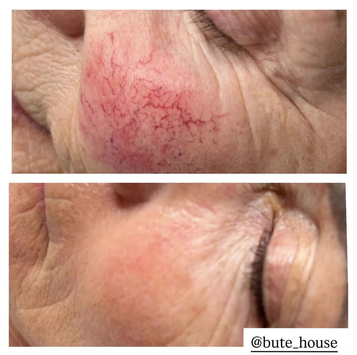 Bute House Aesthetics before and after on face