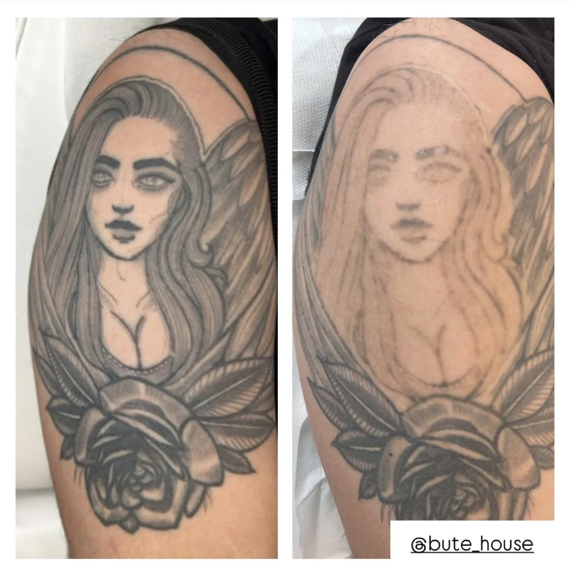 Large tattoo removal in Suffolk