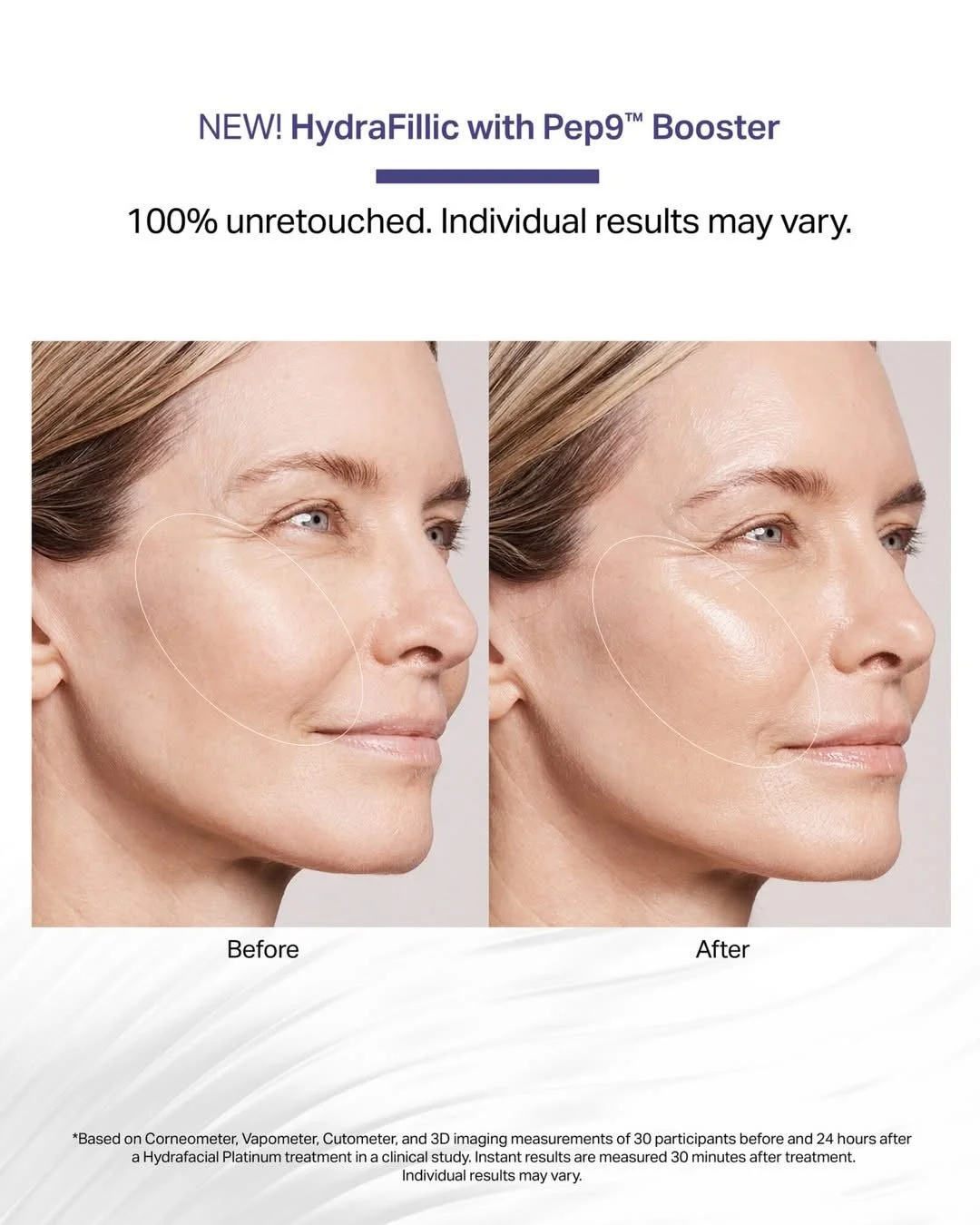 Shows results of HydraFillic on woman