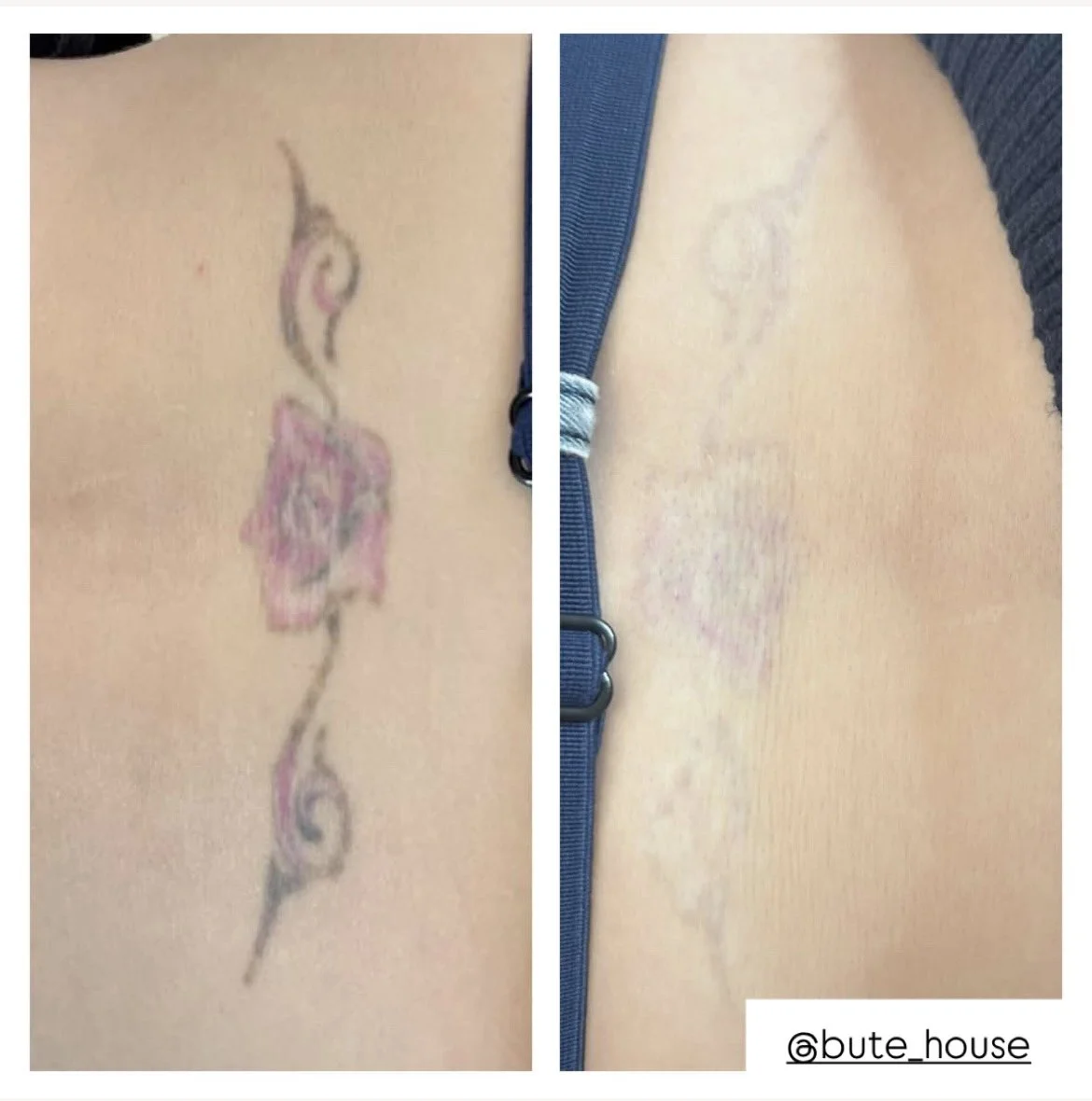 Colour tattoo removal by Bute House Aesthetics in Newmarket