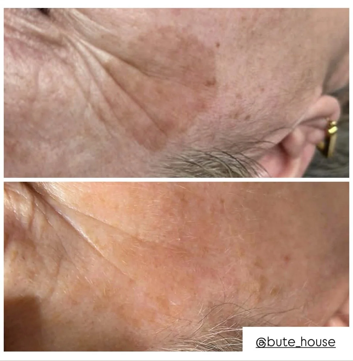 Before and after face by Bute House Aesthetics