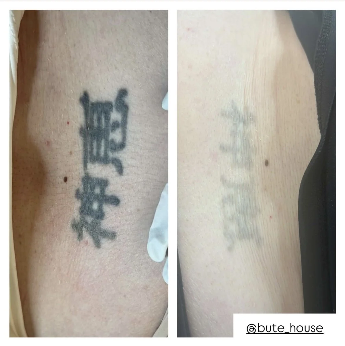Before and after tattoo removal by Bute House Aesthetics in Suffolk