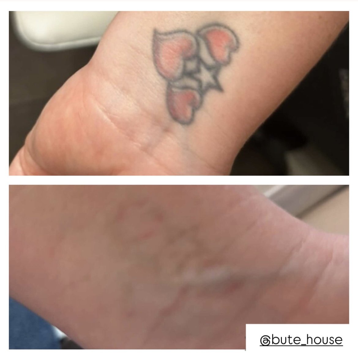 Tattoo removal on wrist by Bute House Aesthetics in Suffolk
