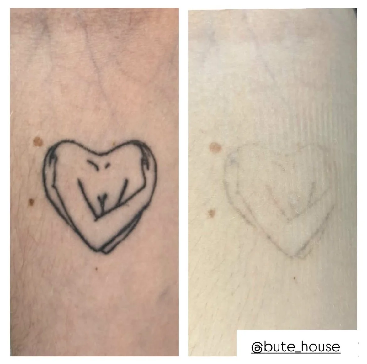 Tattoo removal in Suffolk by the team at Bute House Aesthetics