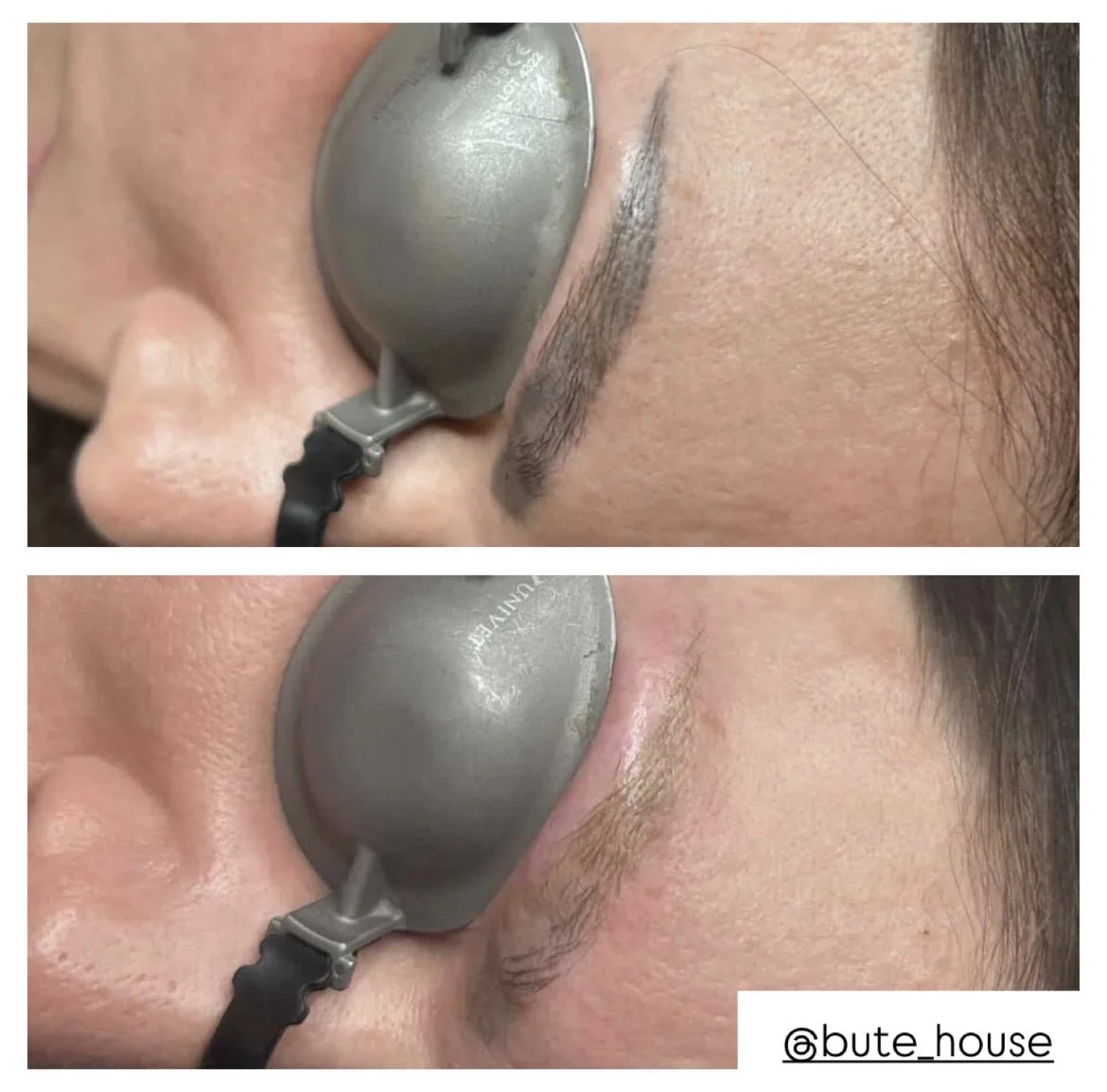 Eyebrow tattoo removal in Suffolk