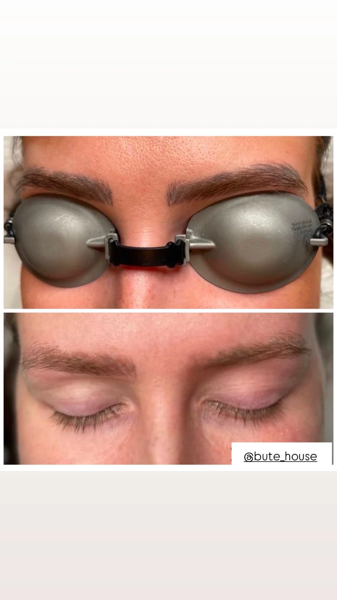 Eyebrow tattoo removal by Bute House Aesthetics in Newmarket