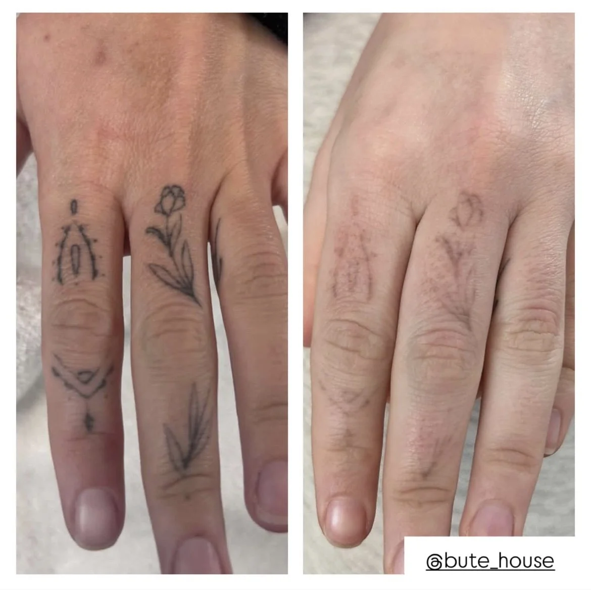 Hand tattoo removal by Bute House Aesthetics in