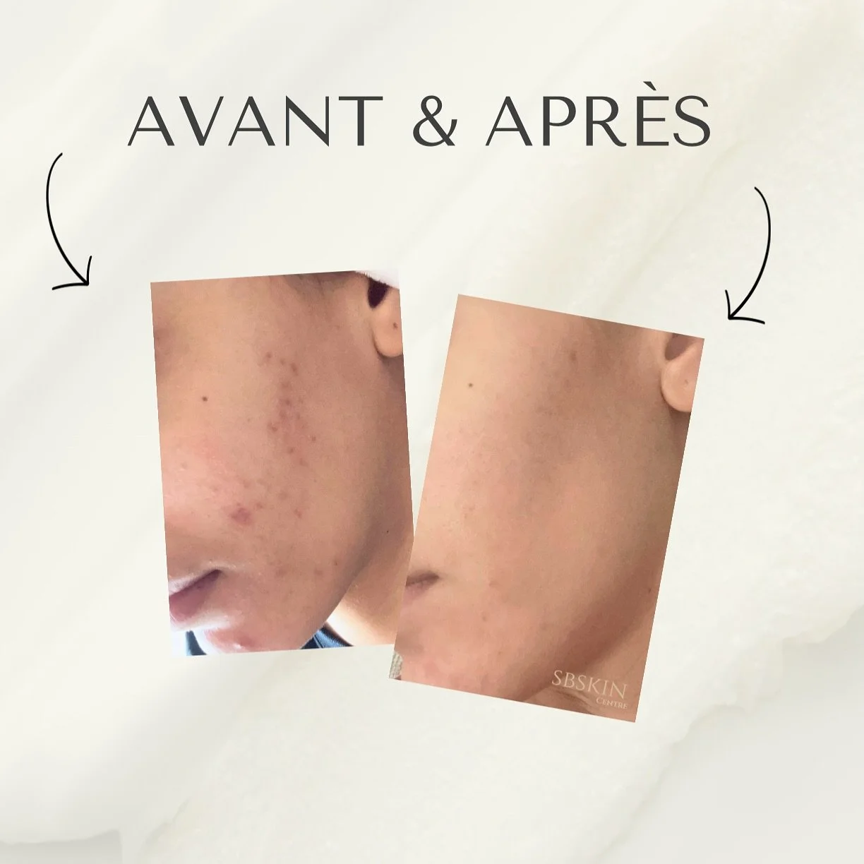 Chez SB Skin, prendre soin de sa peau, c’est agir de l’intérieur comme de l’extérieur.
Acné hormonale, cicatrices, hyperpigmentation… rien n’est une fatalité.
Avec les bons soins et de la pat