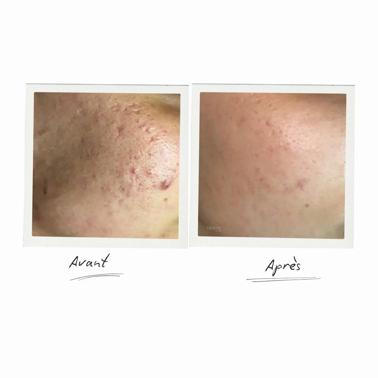 Réduction visible des cicatrices et imperfections ✨
Après plusieurs séances ciblées, une nette amélioration de la texture de la peau est observée, avec atténuation des marques et uniformisation du tei