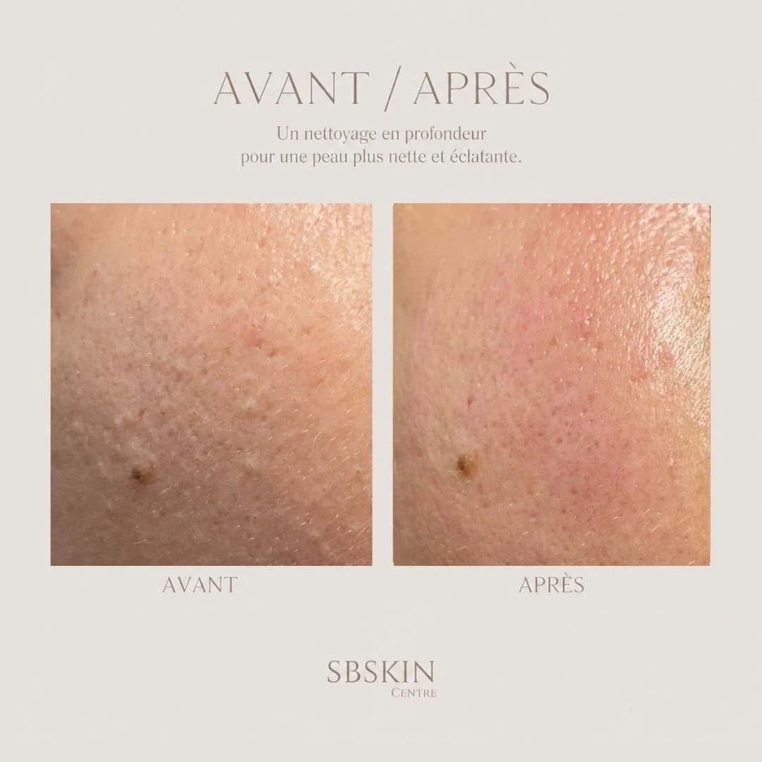 Les changements de saison sont des p&eacute;riodes cl&eacute;s pour la peau. Parmi les moments les plus importants de l'ann&eacute;e pour r&eacute;aliser un nettoyage en profondeur, l'arriv&eacute;e de l'&eacute;t&eacute; est l'une des p&eacute;riode