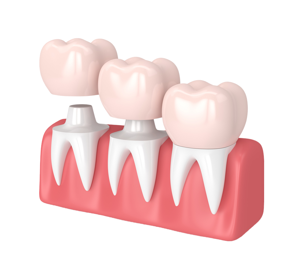 Dental crowns and bridges