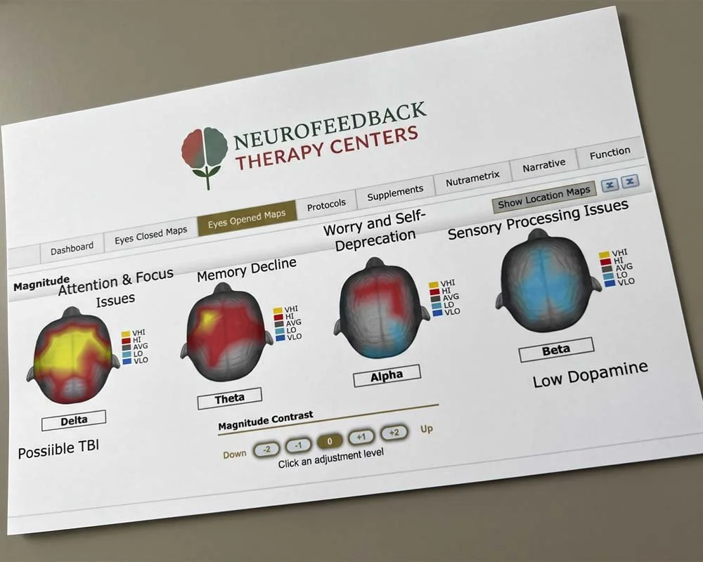 qEEG brain mapping showing electrical brain activity patterns