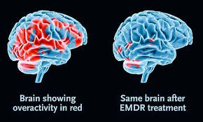 Image of brain showing changes from EMDR therapy/counseling