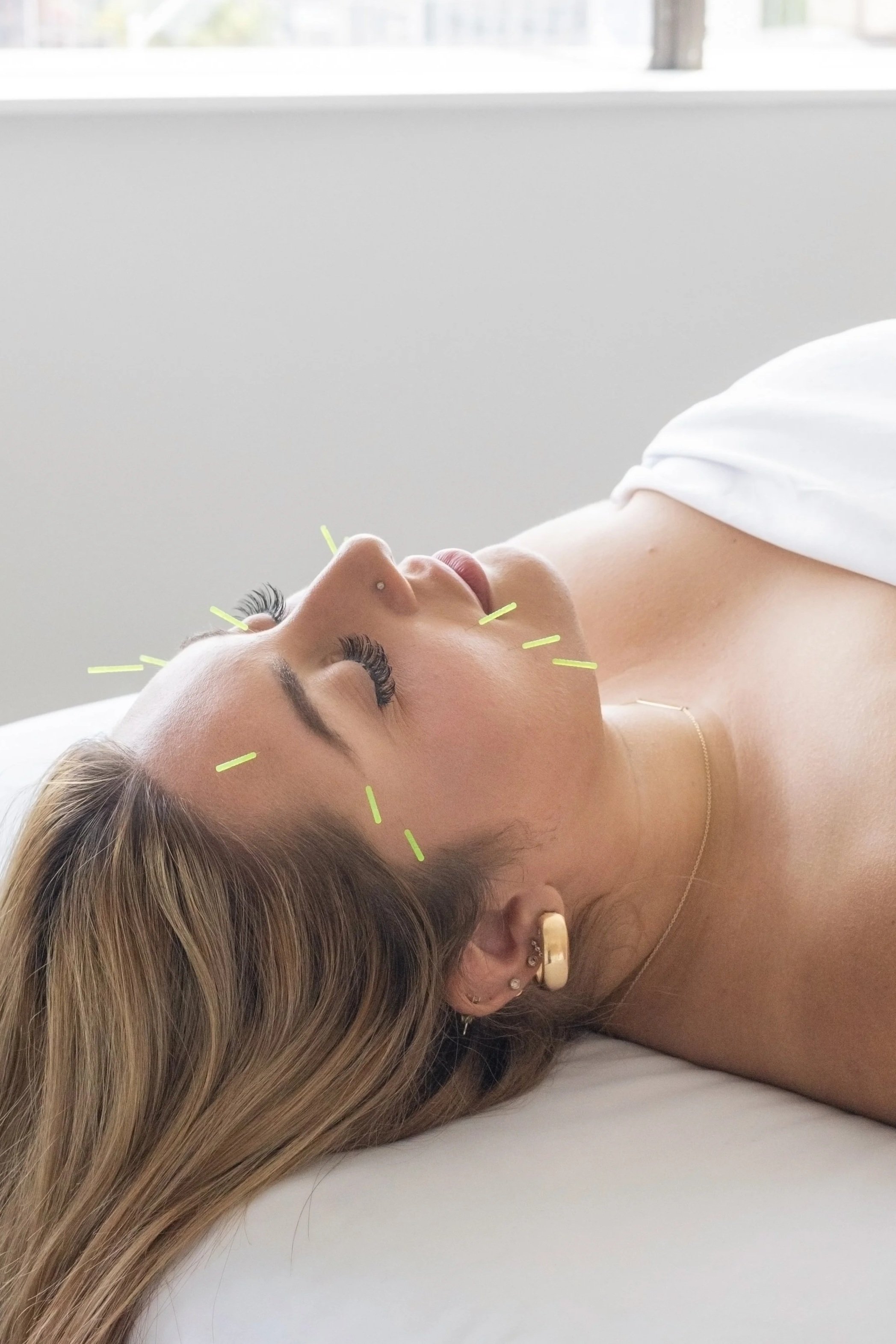 Cosmetic acupuncture treatment in Bloor West Village promoting natural anti-aging and longevity from the inside out
