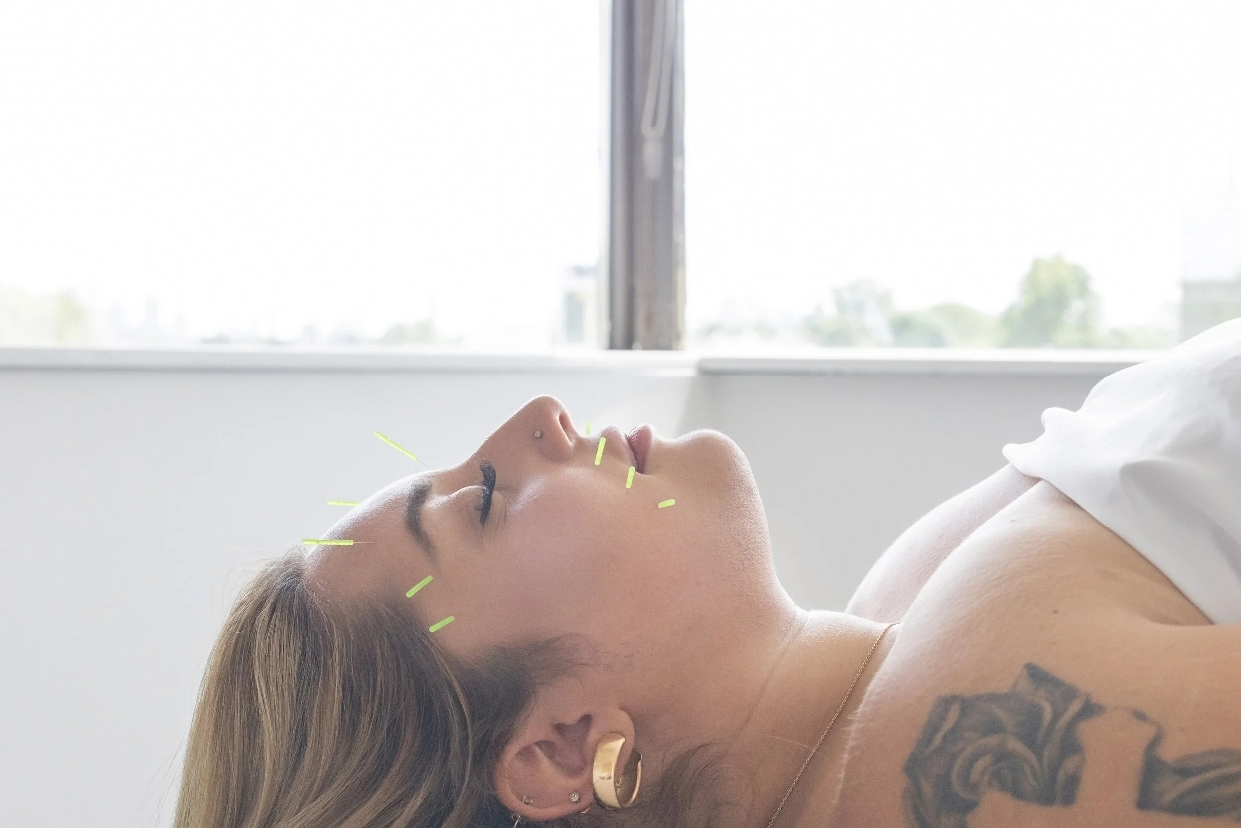 Botox Is Trending… But Cosmetic Acupuncture Has Been Doing “Longevity” for Centuries