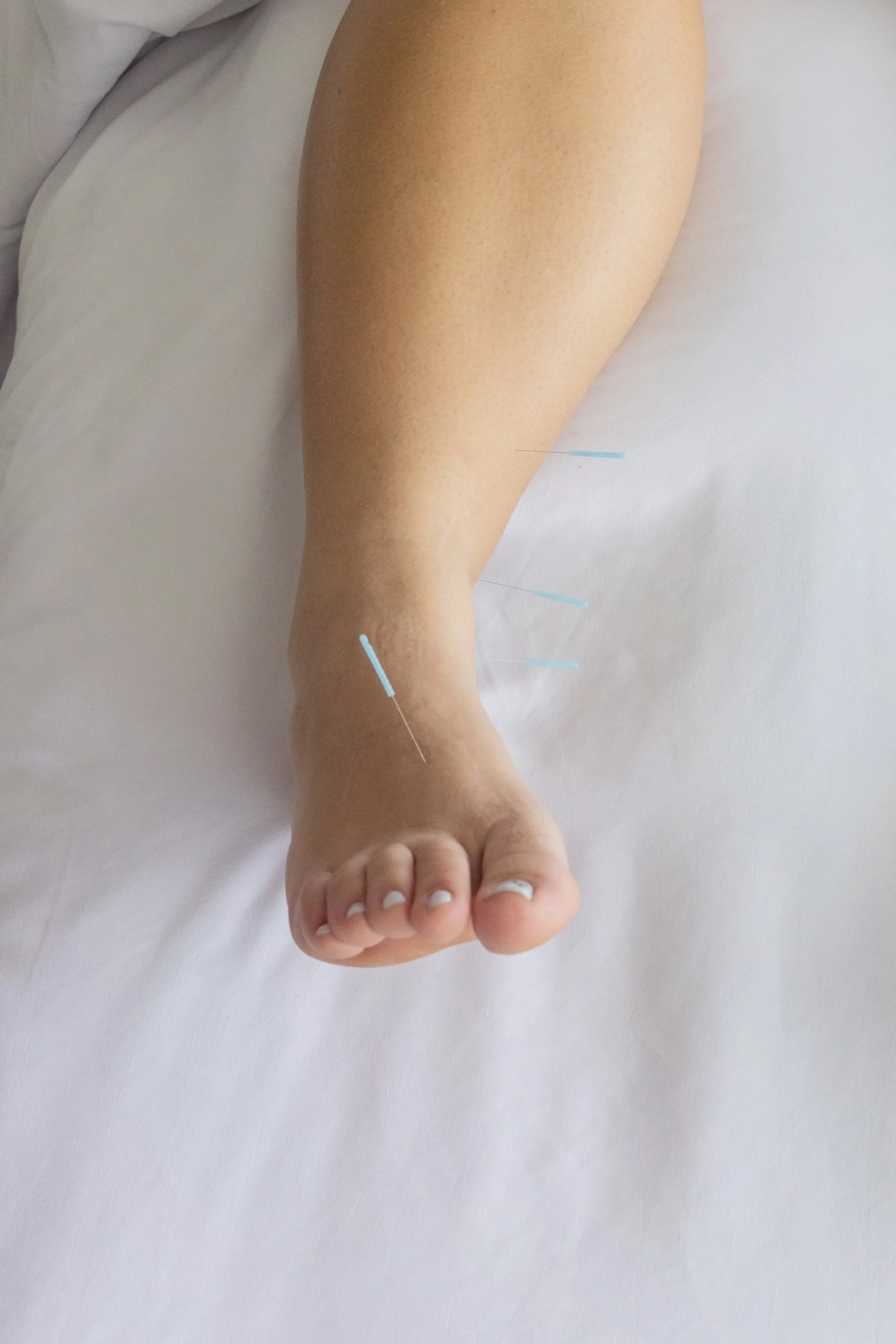 Feeling Bloated? What Your Body Might Be Trying to Tell You and How Acupuncture Can Help in West Toronto