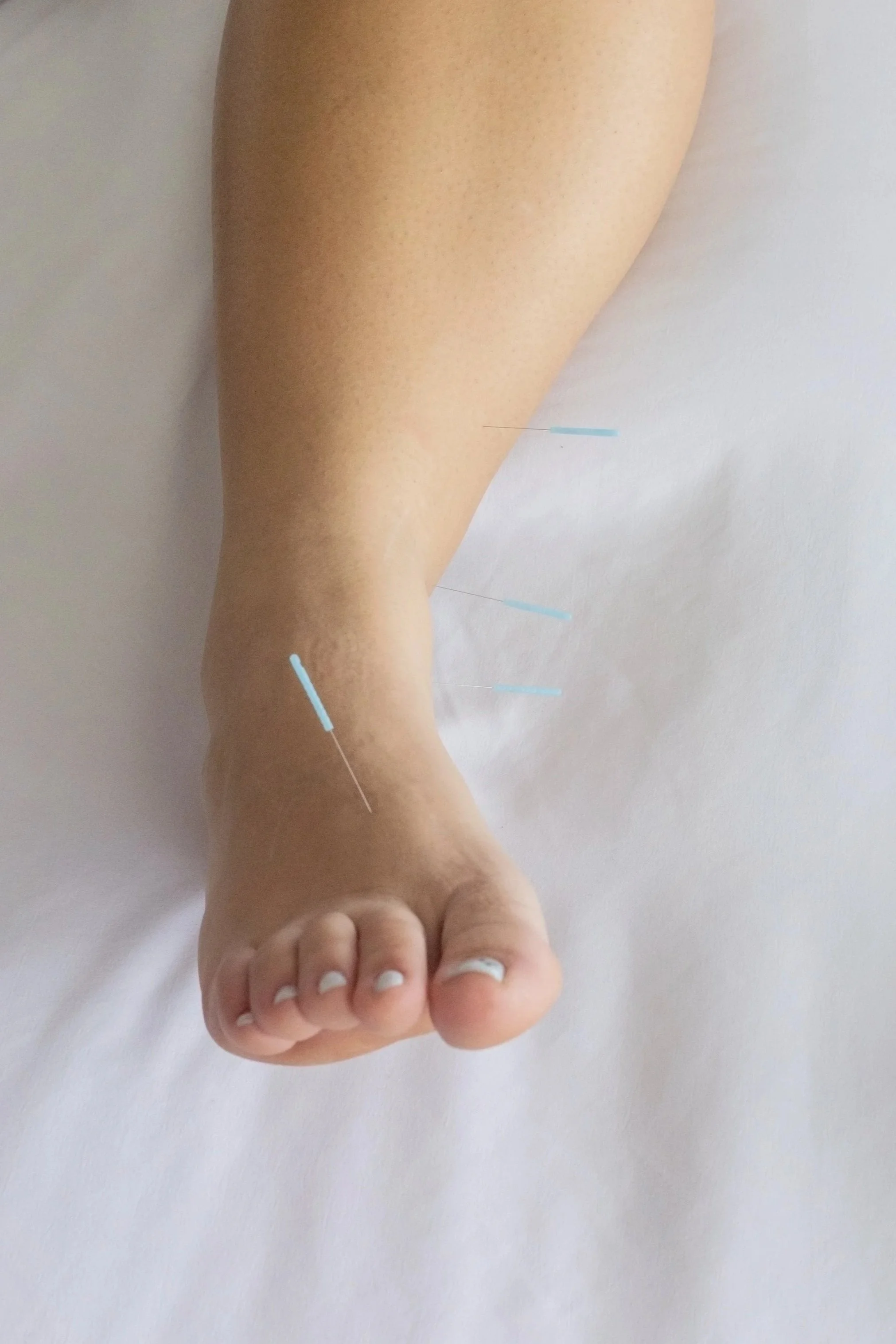 Woman receiving acupuncture treatment in West Toronto clinic for bloating relief, promoting digestion and relaxation in a calm wellness setting.