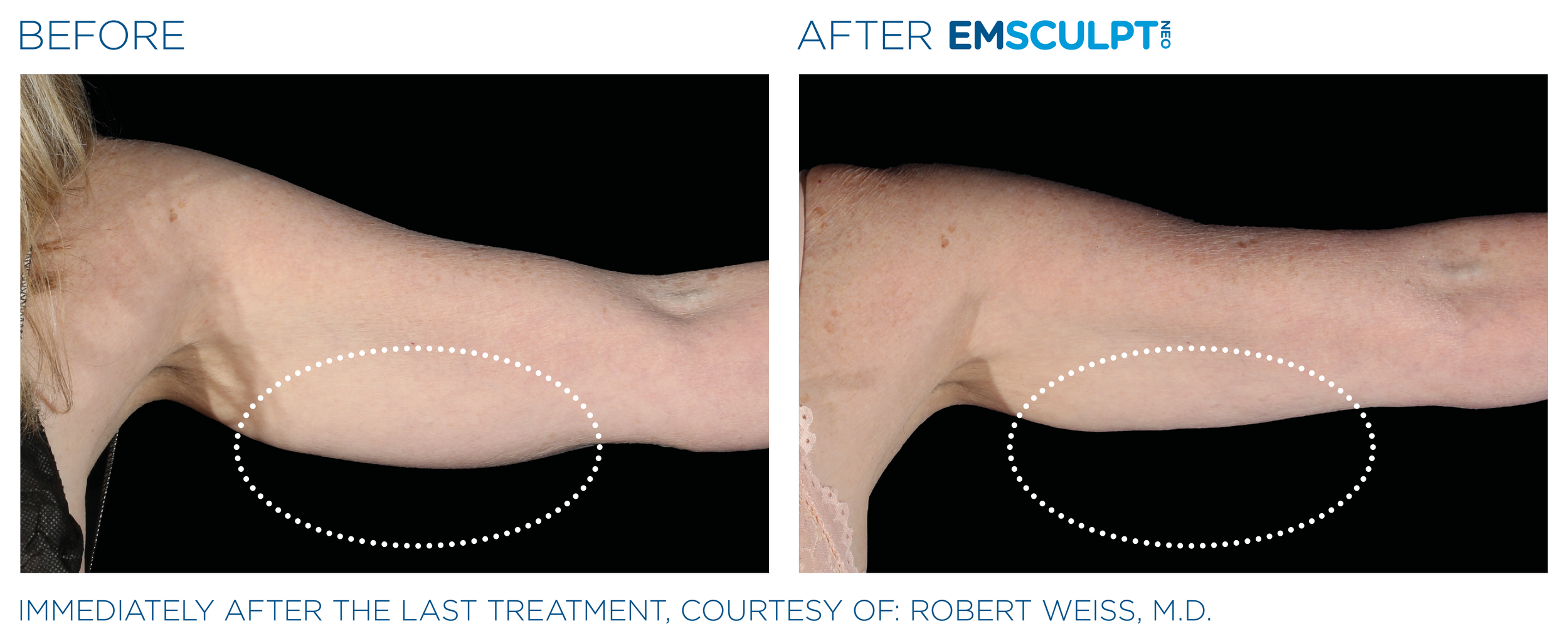 EmSCULPT NEO Before & After (5).png