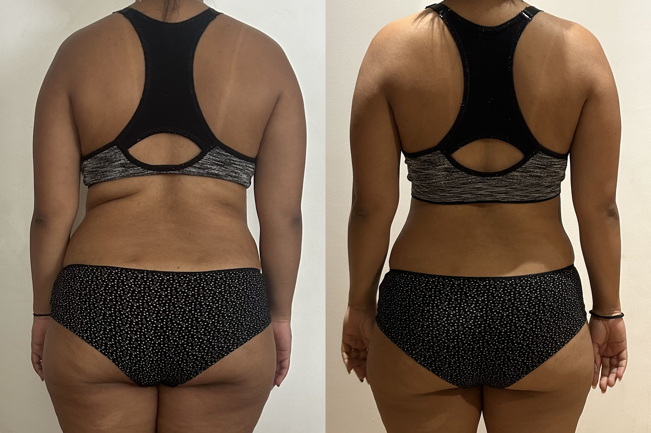 Comparaison avant et après d'une femme montrant une réduction de la graisse corporelle, portant un haut noir et un bas de sous-vêtements noir à motifs blancs, vue de dos.