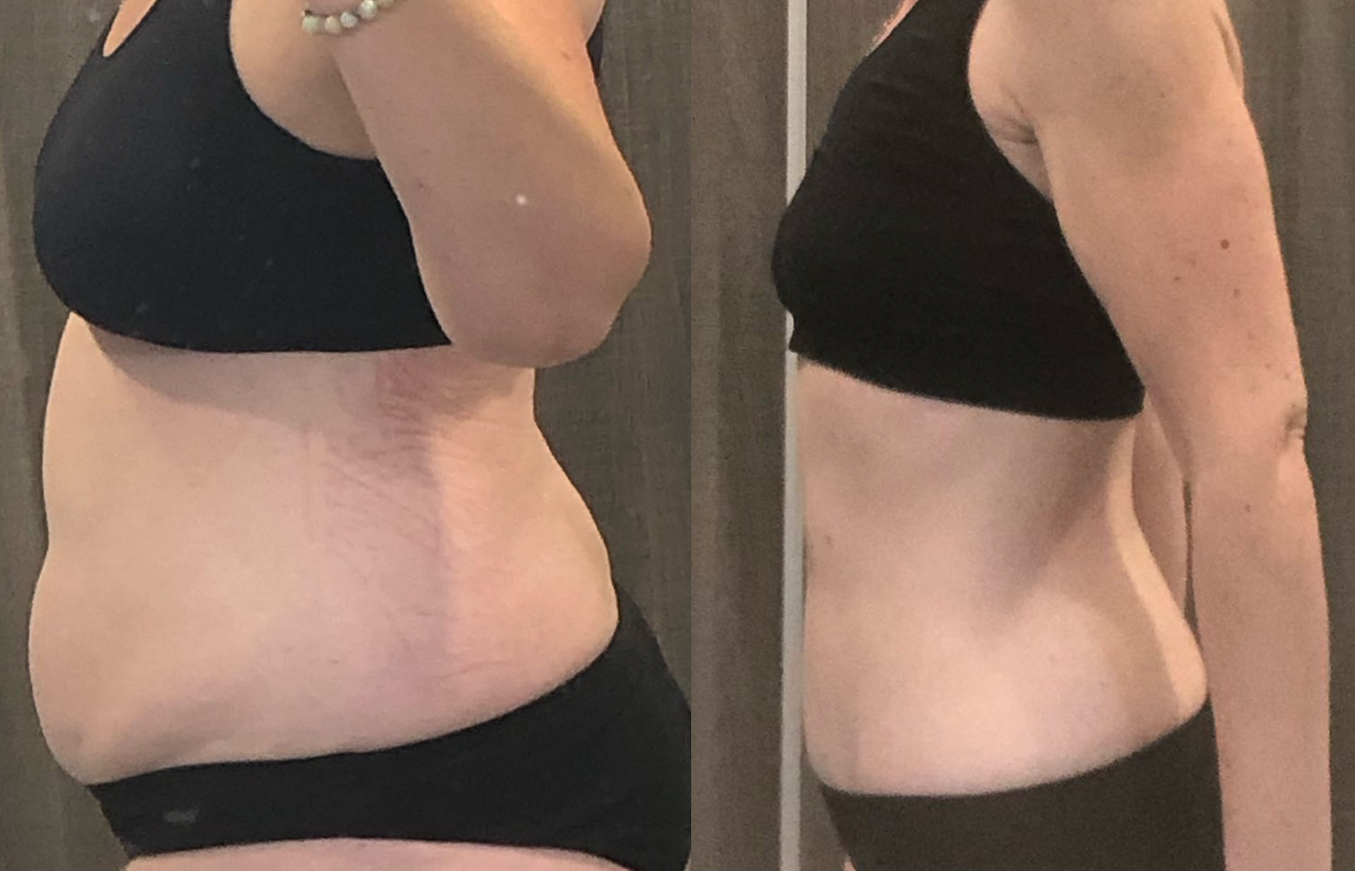 Comparaison avant et après d'une perte de poids, montrant la silhouette d'une femme vue de profil.