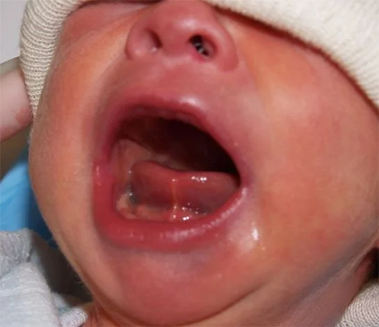 Infants with Oral Ties in North Arlington, TX