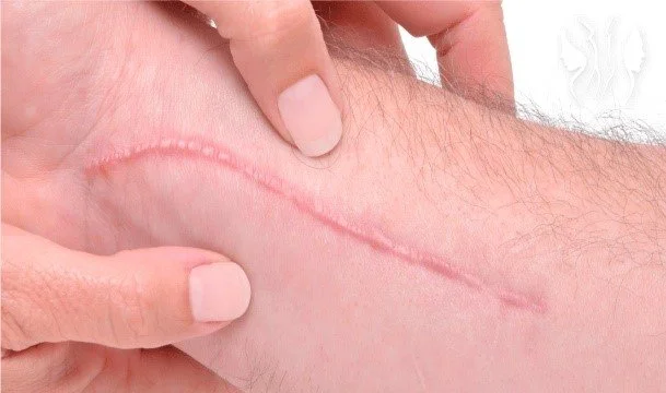 Terapia Manual para Cicatrices Postquirúrgicas (ScarWork)