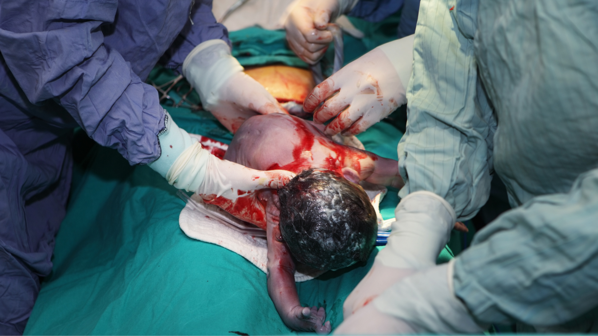 C-Section Tips for Dads and Partners