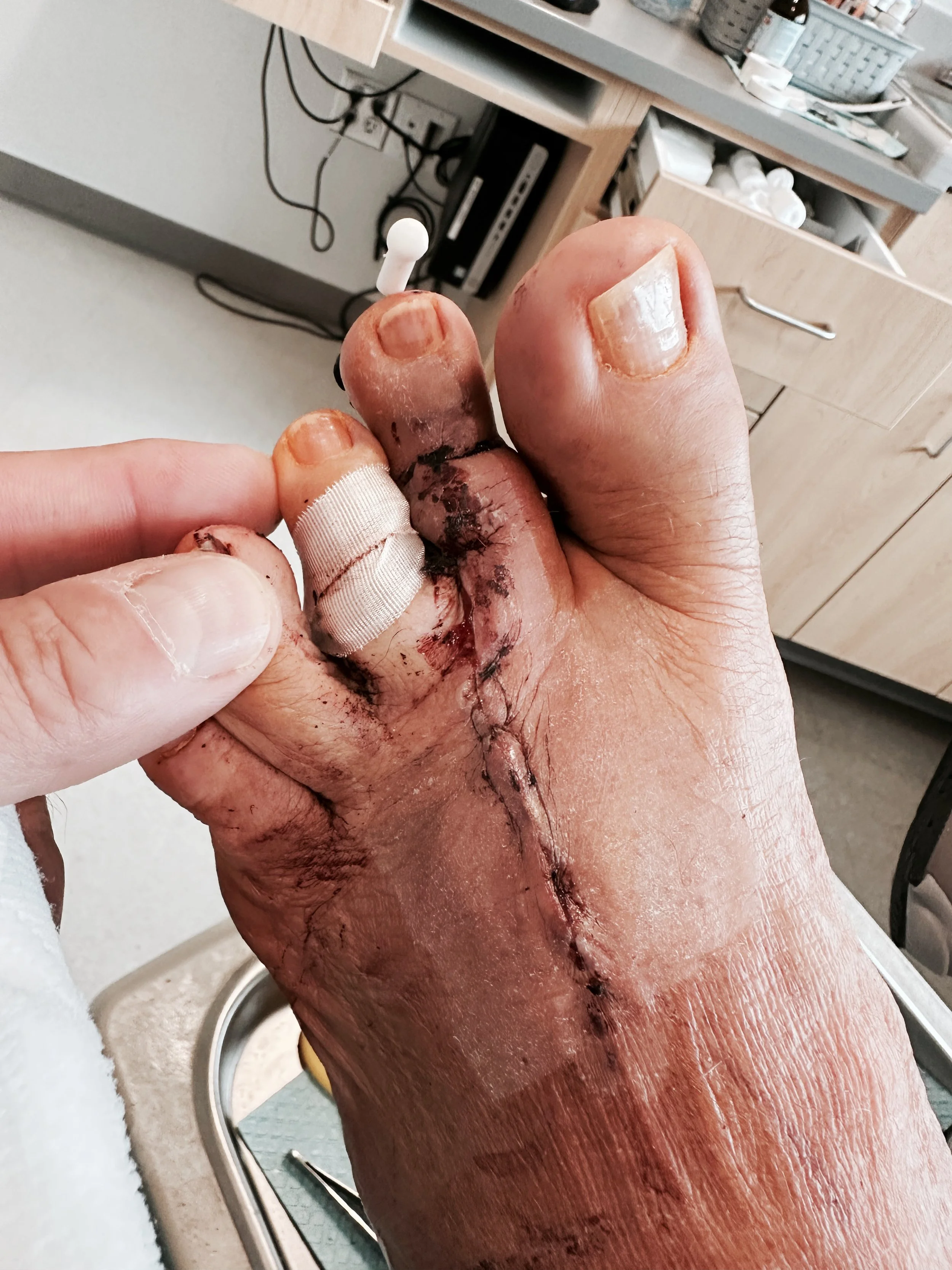 Frankentoes and Gastronomical Woes