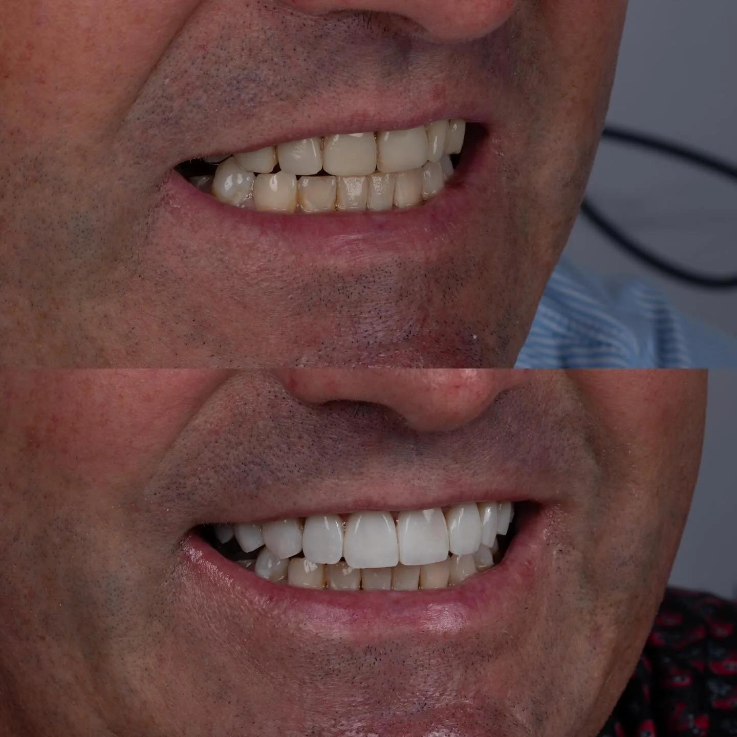 If you&rsquo;ve been told that the only way to have a smile you are proud of, is to damage your teeth, then come see me! This is another case where we have removed Porcelain Veneers (the &ldquo;Gold Standard&rdquo;) and have replaced them with our co