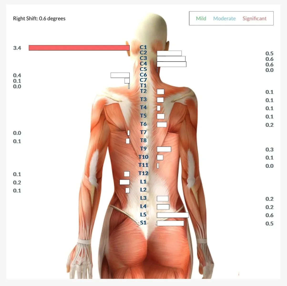 Muscle tension scan chart showing a 0.6-degree right shift with measurements along the spine.