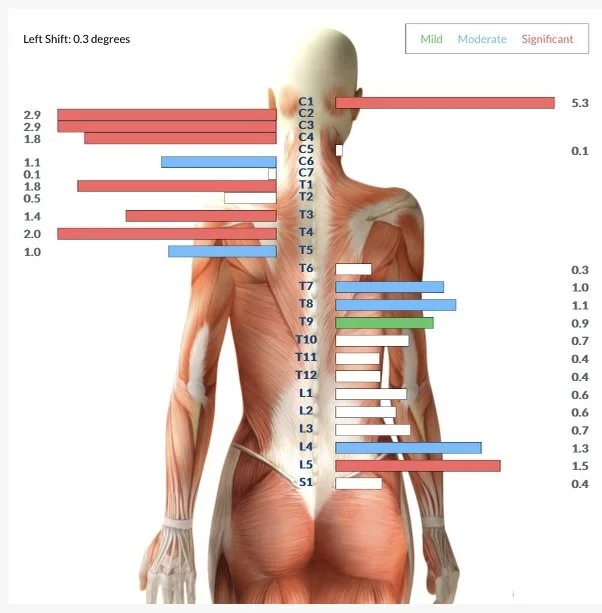 Electromyography scan showing levels of muscle activation with color coding for mild, moderate, and significant, overlaid on a human muscular anatomy diagram.