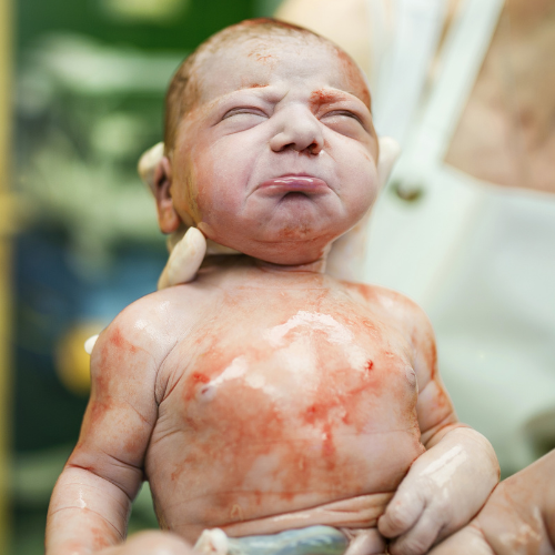 A newborn baby with vernix caseosa and skin redness, being held by a medical professional during a birth.