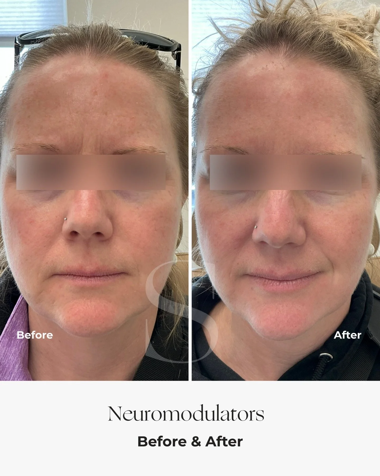 When soft, subtle refinement creates the most meaningful impact.

For this client, we treated the crow&rsquo;s feet, frown lines, and DAO muscles (responsible for the downward pull at the corners of the mouth) using neuromodulators. The goal was not 