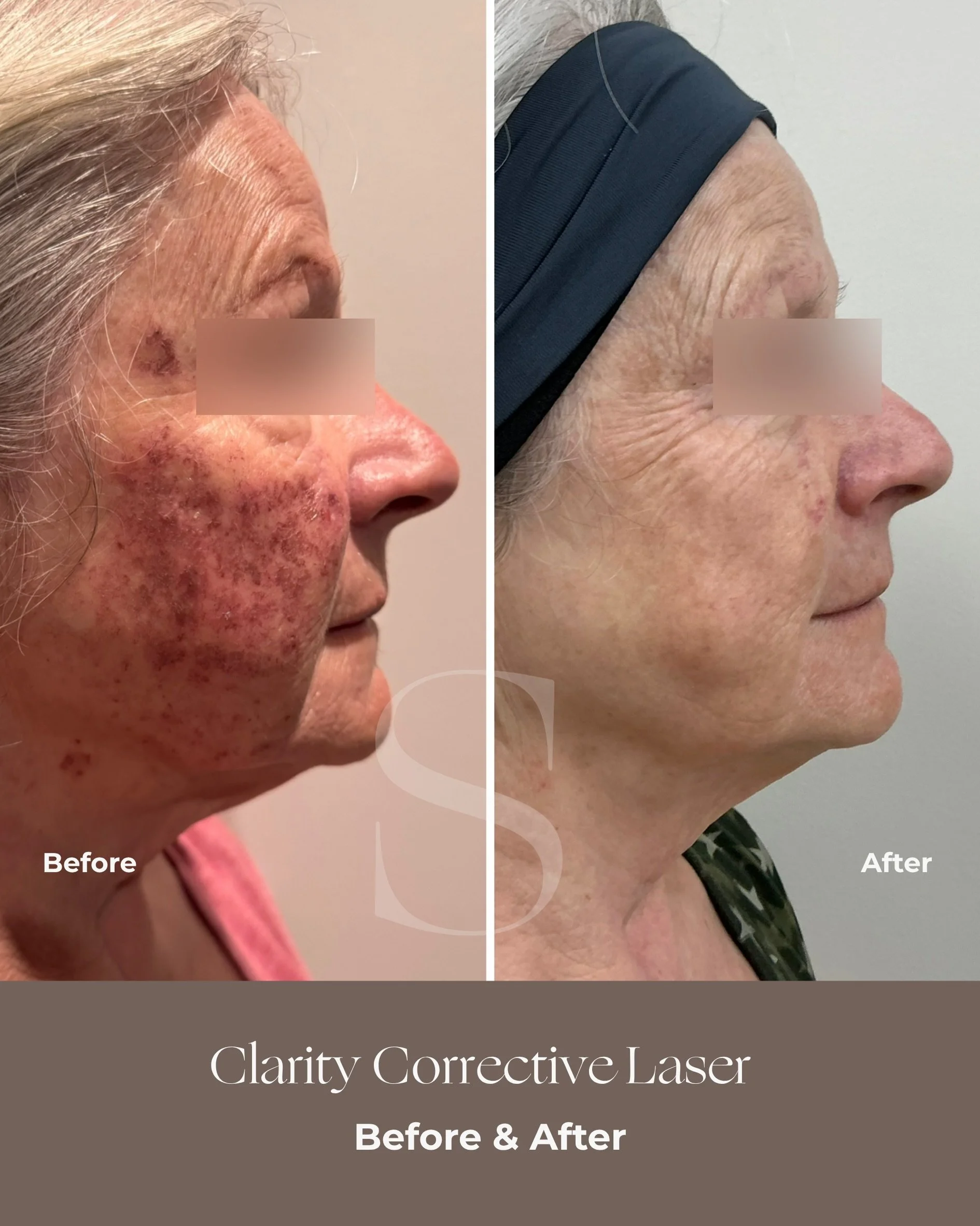Pigment and sun damage don&rsquo;t usually appear overnight.

They build slowly over years of cumulative exposure which is why so many people are surprised by how much can surface once treatment begins.

These before photos were taken just 48 hours a