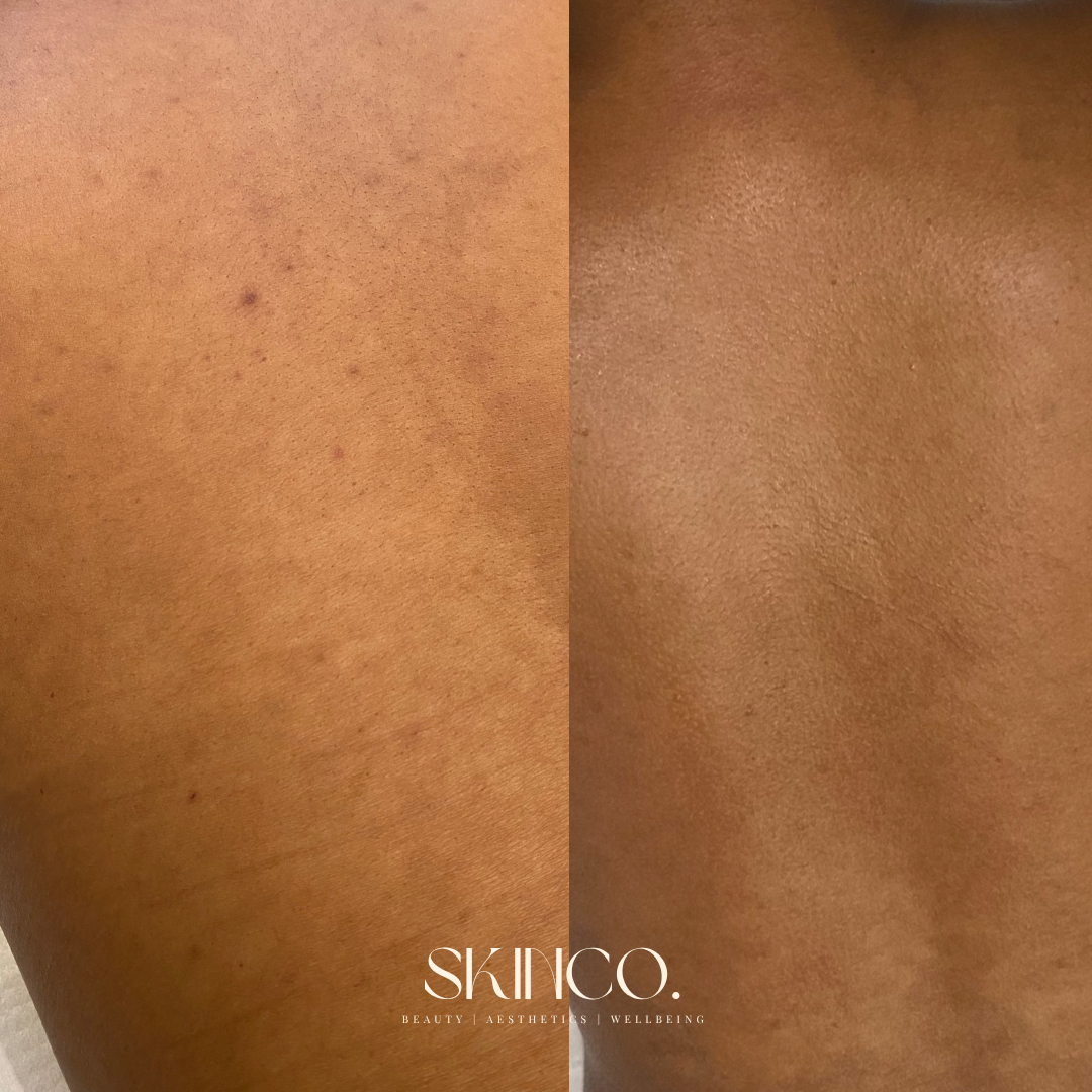 Close-up comparison of skin before and after skincare treatment, showing clearer, smoother skin on the right side.