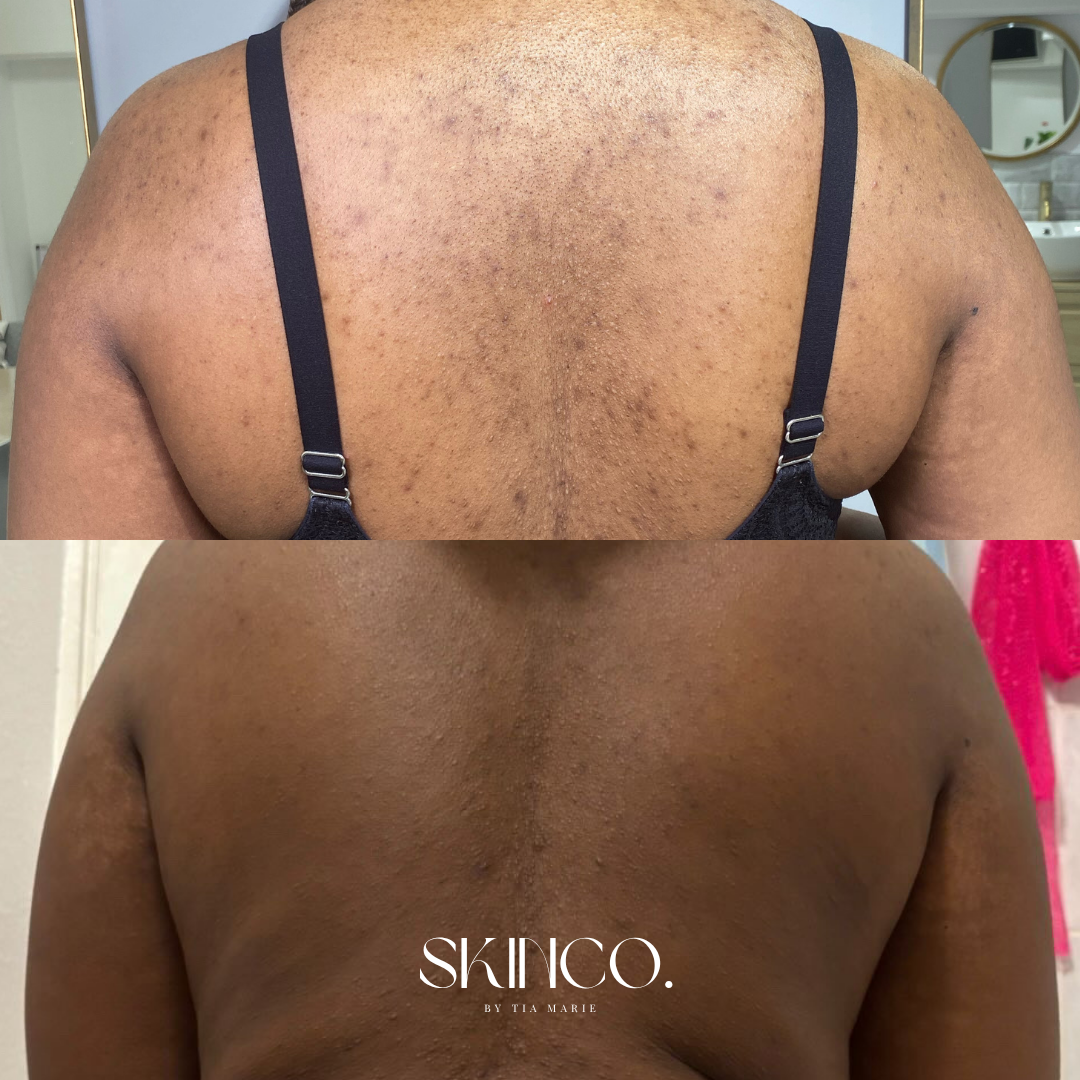 Side-by-side comparison of a person's back before and after skincare treatment showing improvement in skin texture and appearance.