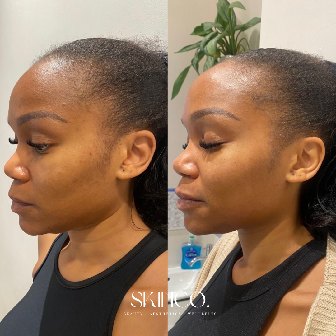 Side-by-side comparison of a woman before and after skincare treatment, showing improved skin clarity and texture.