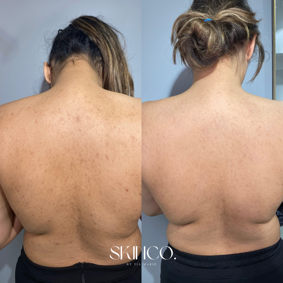 Side-by-side comparison of a woman's back before and after skincare treatment showing clearer, smoother skin with fewer blemishes.