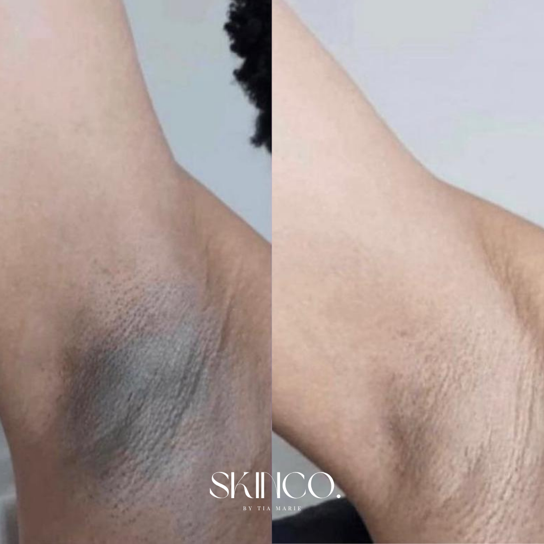 Comparison of underarm skin before and after hair removal or skin treatment, showing reduced hair and smoother skin.