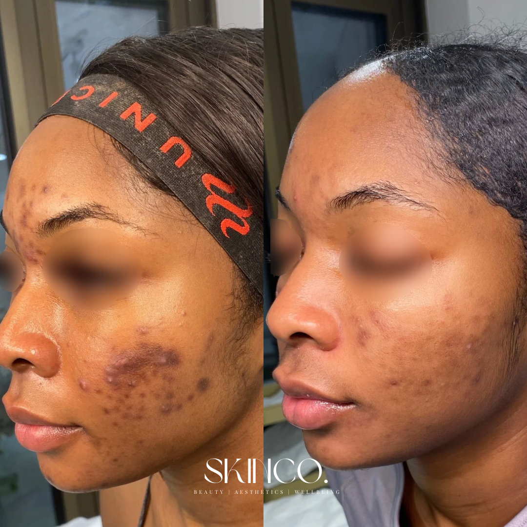 Side-by-side comparison of a woman's face before and after acne treatment, showing reduction in acne scars and skin clarity.