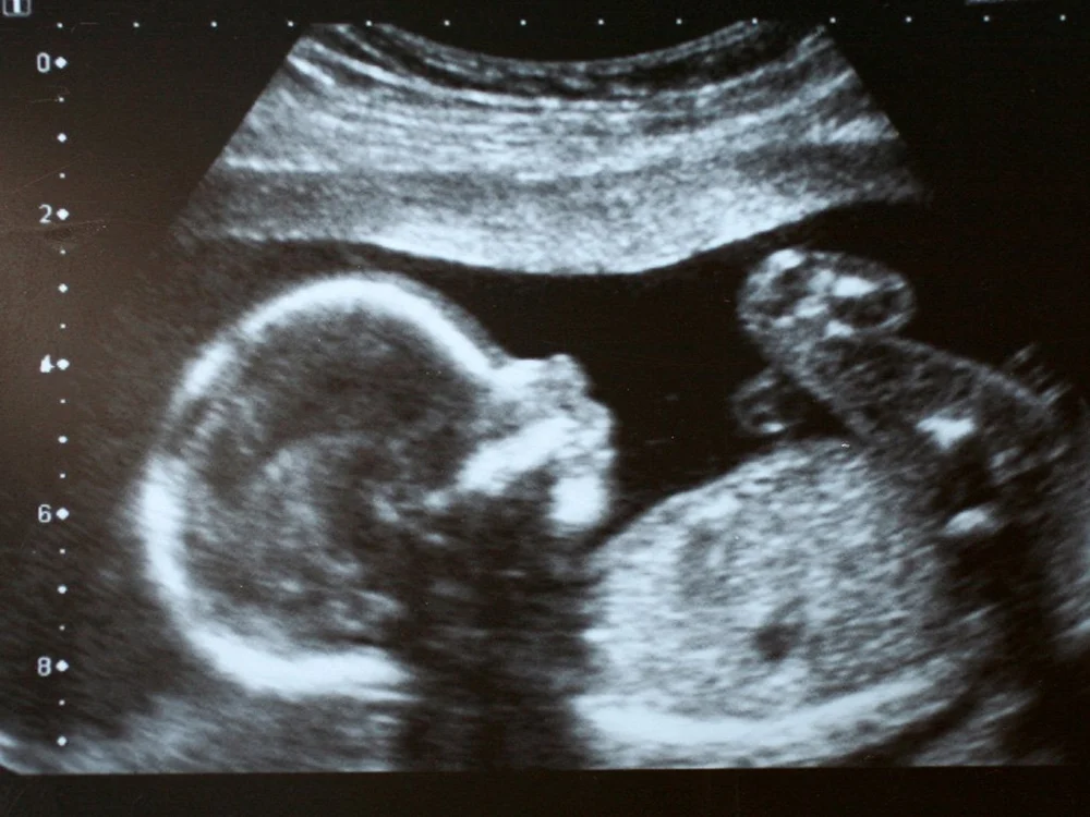 Prenatal pregnancy ultrasound showing fetal imaging during a clinic appointment