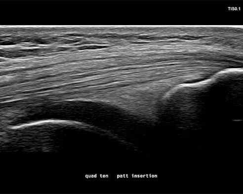 Musculoskeletal ultrasound imaging of muscles, tendons, and joints for injury assessment at a Saskatoon clinic