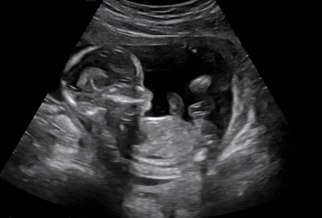 2D ultrasound showing baby’s profile during an elective ultrasound in Houston