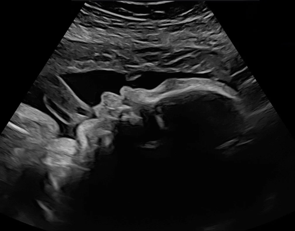 baby-bliss-ultrasound-2d-baby-image.jpg