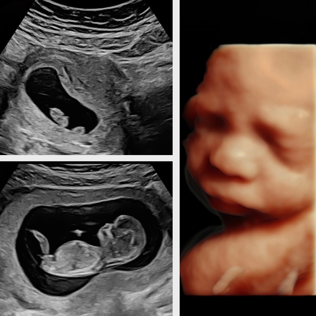 Comparison of 2D, 3D, 4D, and HD Live pregnancy ultrasound images at Baby Bliss Ultrasound in Houston, TX