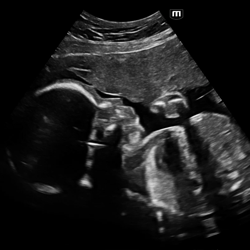 Ultrasound image of a developing fetus inside the mother's womb