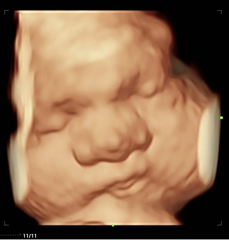 3D ultrasound image showing a baby's face during pregnancy