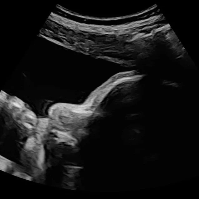 2D ultrasound image of baby at Baby Bliss Ultrasound in Houston
