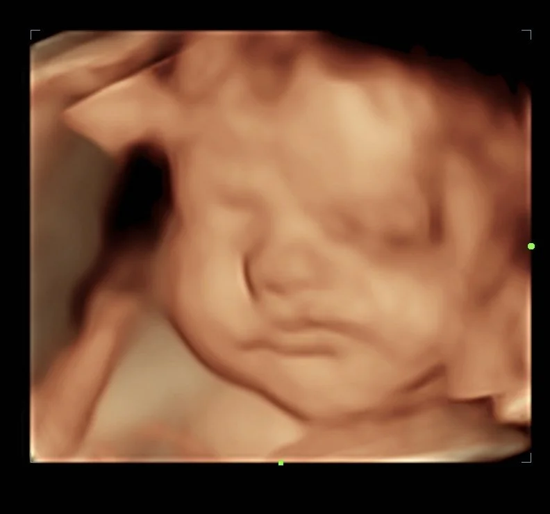 Close-up 3D ultrasound view of a baby's face before birth